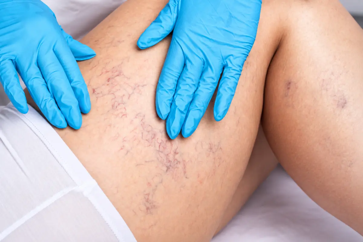 Besenreiser en las piernas